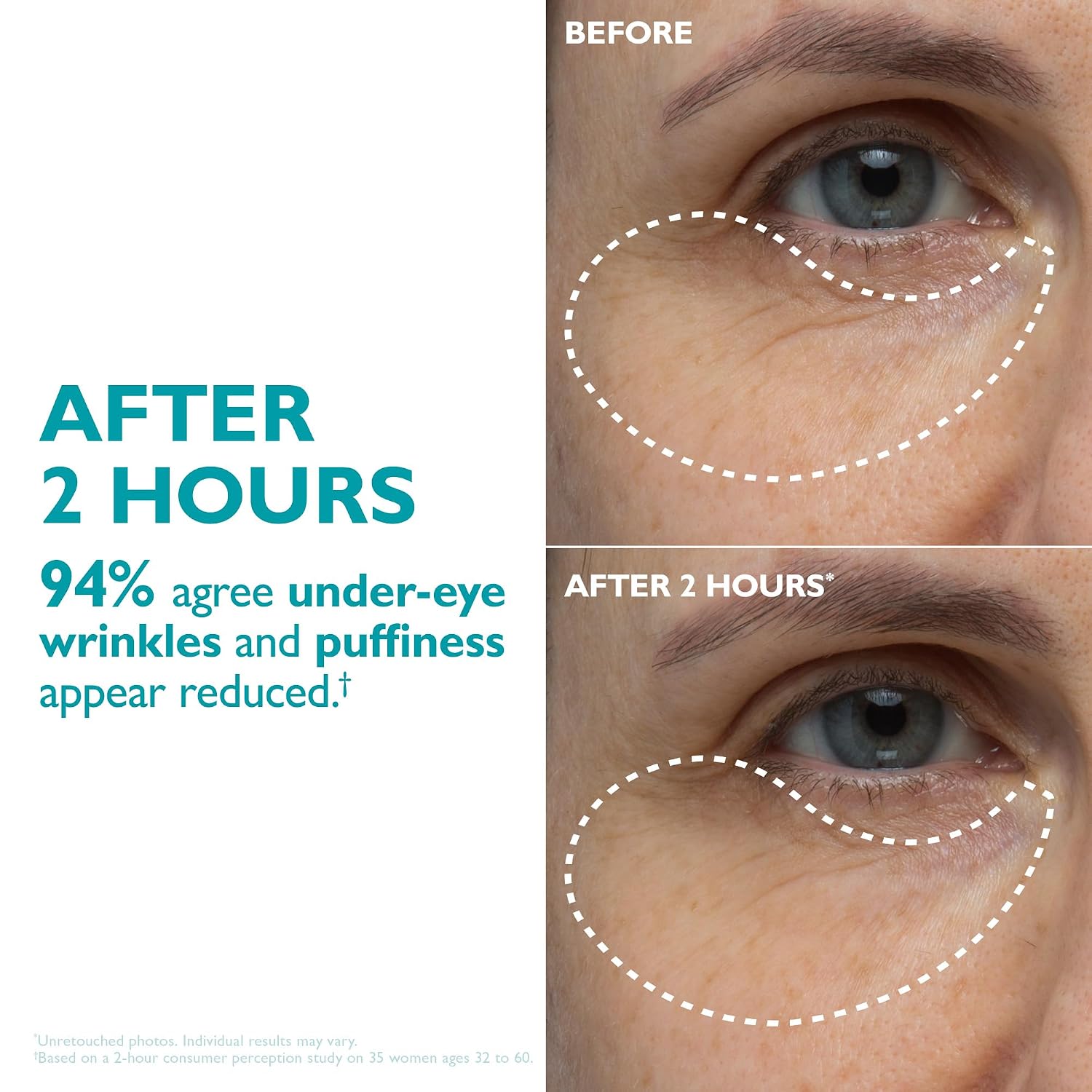 Peptide patches for wrinkles and Under eye bags